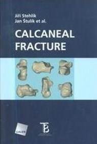 Calcaneal fracture